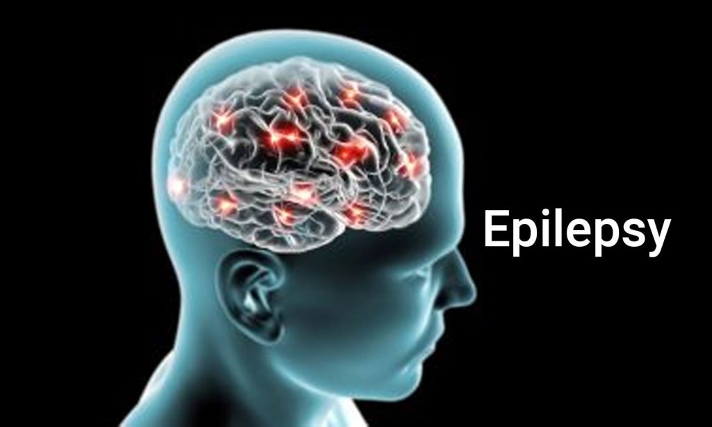 What Causes Epilepsy?