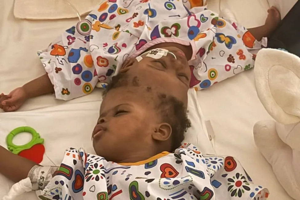 How AI Helped Nigerian Conjoined Twins See Each Other for the First Time