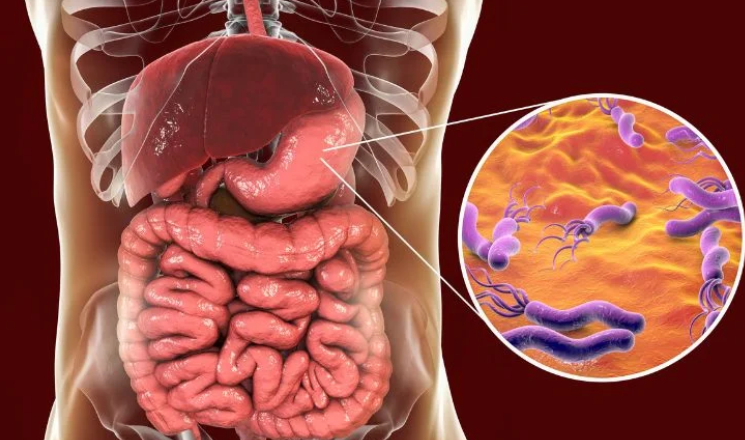 Helicobacter pylori bacteria in the stomach